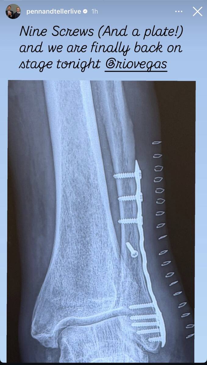 An X-ray of Penn Jillette's broken left ankle, posted by on Penn and Teller's official Instagra ...